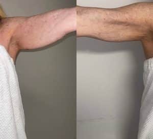 Body Contouring With Alma After 4 Treatments