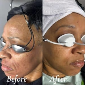 Laser Skin Resurfacing After 1 Treatment